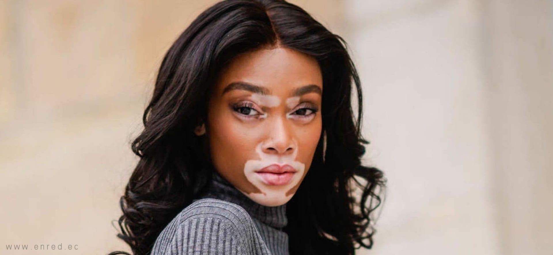 Médicos descubren la cura para la enfermedad vitiligo ENRED